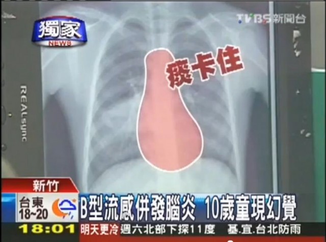 tvbs flu b 1.JPG