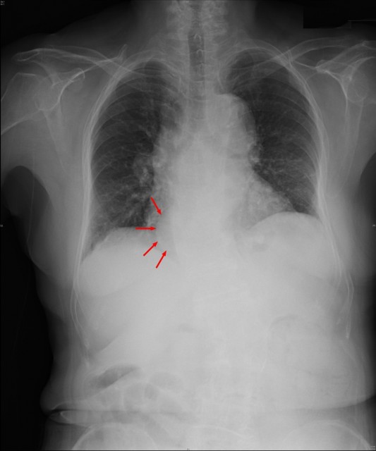 CXR_s.jpg